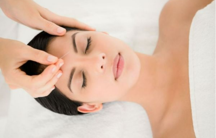 Điện châm điều trị rối loạn chức năng tiền đình (Huyễn vựng)